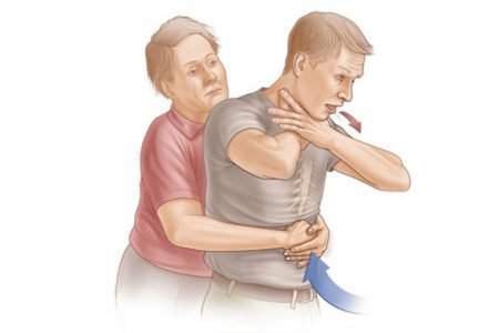 Zadławienie – Pierwsza Pomoc