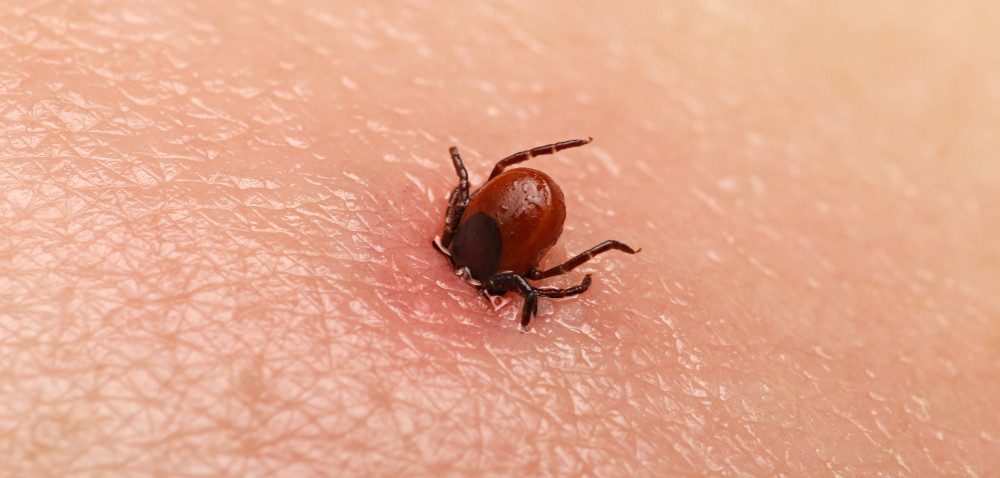 Borelioza oraz zapalenie mózgu – typowe choroby odkleszczowe. Jak usunąć kleszcza?